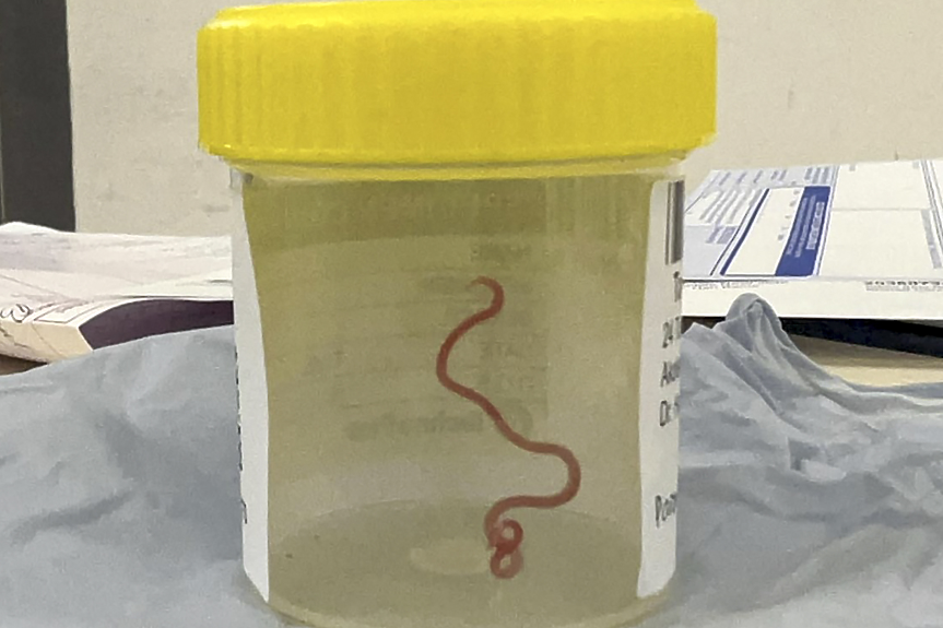 Жив и гърчещ се. 8-сантиметров червей в мозъка на австралийка
