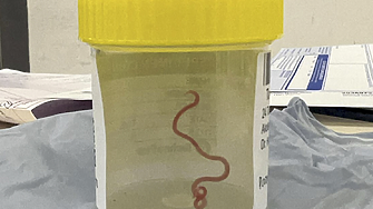 Жив и гърчещ се. 8-сантиметров червей в мозъка на австралийка