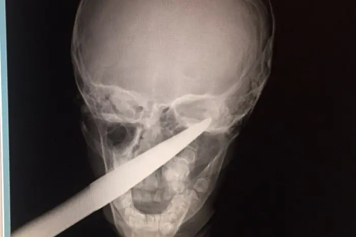 В бургаска болница спасиха дете със забита в главата градинска ножица