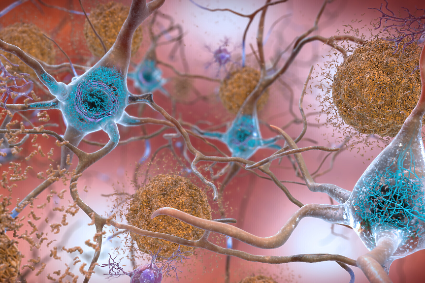 Изследване: Ново лекарство забавя развитието на болестта на Алцхаймер