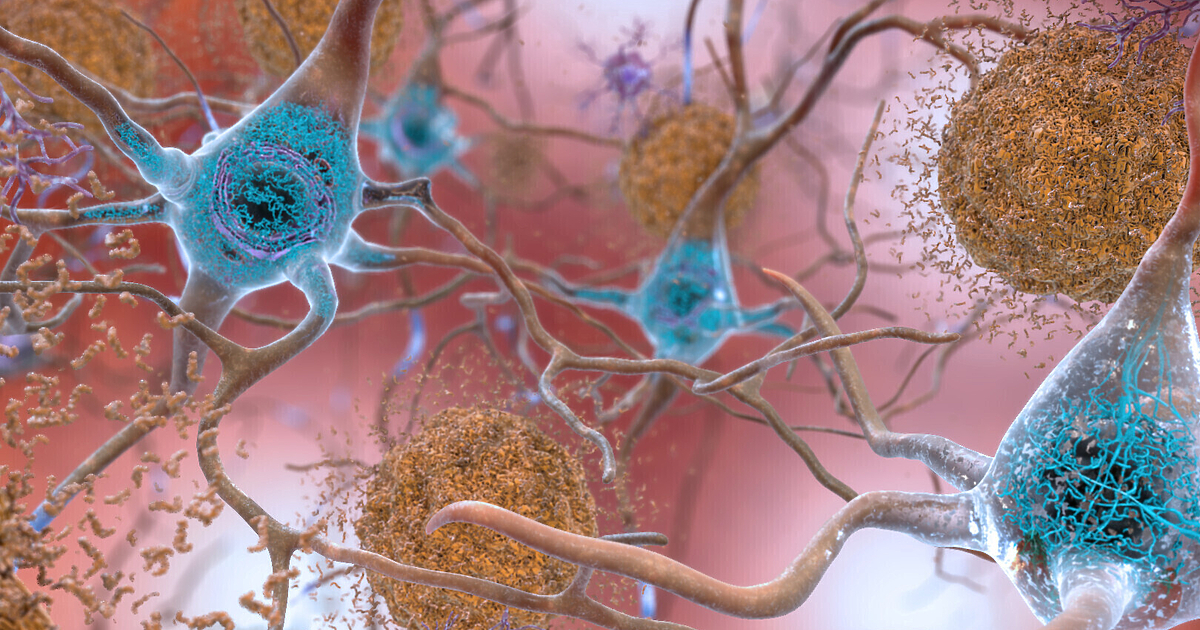 Учени приветстват новия етап от битката с болестта на Алцхаймер,