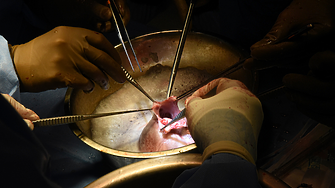 Два дни след като получи свинско сърце: трансплантираният разказва вицове