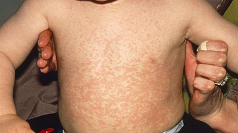 Румъния е огнище на морбили в Европа